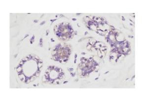 AKT1 + AKT2 + AKT3 Antibody - Immunohistochemistry of rabbit anti-AKT pS473 antibody. Tissue: human breast carcinoma. Fixation: formalin fixed paraffin embedded. Antigen retrieval: not required. Primary antibody: AKT pS473 antibody at 1:100 for 1 h at RT. Secondary antibody: Dako's Techmate streptavidin-biotin reagents at 1:10,000 for 45 min at RT. Localization: AKT pS473 is nuclear and occasionally cytoplasmic.