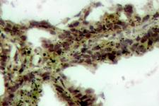AKT1 + AKT2 + AKT3 Antibody - IHC of p-Akt (T308) pAb in paraffin-embedded human lung carcinoma tissue.