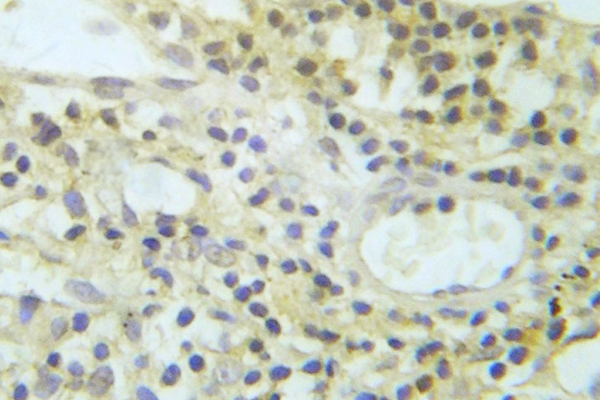 AKT1 + AKT2 + AKT3 Antibody - IHC of p-Akt (Y326) pAb in paraffin-embedded human lung adenocarcinoma tissue.