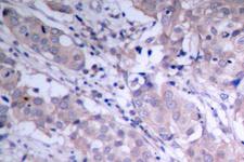 AKT1 + AKT2 + AKT3 Antibody - IHC of Akt (P467) pAb in paraffin-embedded human breast carcinoma tissue.