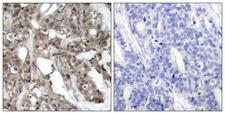 AKT1 + AKT2 Antibody - Immunohistochemistry analysis of paraffin-embedded human breast carcinoma tissue, using Akt Antibody. The picture on the right is blocked with the synthesized peptide.