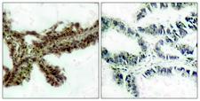 AKT1 + AKT2 Antibody - Immunohistochemistry analysis of paraffin-embedded human lung carcinoma, using Akt (Phospho-Thr308) Antibody. The picture on the right is blocked with the phospho peptide.
