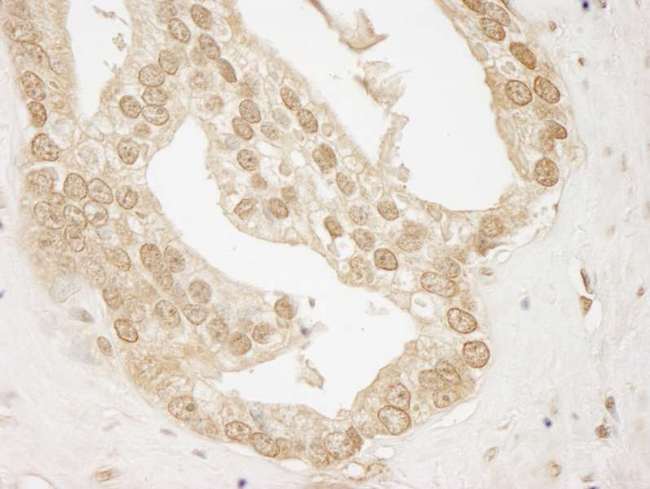 AKT1 Antibody - Detection of Human AKT1 by Immunohistochemistry. Sample: FFPE section of human prostate carcinoma. Antibody: Affinity purified rabbit anti-AKT1 used at a dilution of 1:250.