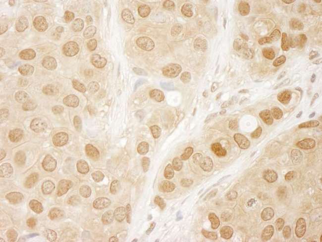 AKT1 Antibody - Detection of Human AKT1 by Immunohistochemistry. Sample: FFPE section of human breast carcinoma. Antibody: Affinity purified rabbit anti-AKT1 used at a dilution of 1:250.