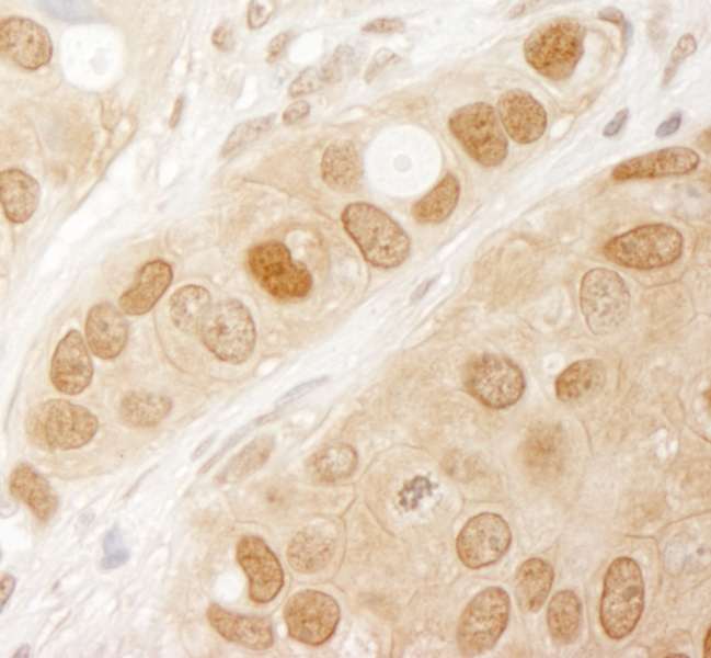 AKT1 Antibody - Detection of Human AKT1 by Immunohistochemistry. Sample: FFPE section of human breast carcinoma. Antibody: Affinity purified rabbit anti-AKT1 used at a dilution of 1:1000 (1 ug/ml).