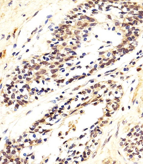 AKT1 Antibody - Immunohistochemical of paraffin-embedded H. prostate carcinoma section using AKT1/2/3 Antibody. Antibody was diluted at 1:25 dilution. A peroxidase-conjugated goat anti-rabbit IgG at 1:400 dilution was used as the secondary antibody, followed by DAB staining.