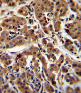 AKT1 Antibody - AKT1 Antibody (C-term T450) immunohistochemistry of formalin-fixed and paraffin-embedded human breast carcinoma followed by peroxidase-conjugated secondary antibody and DAB staining.