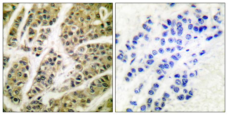 AKT1 Antibody - Peptide - + Immunohistochemistry analysis of paraffin-embedded human breast carcinoma tissue, using Akt (Ab-473) antibody.