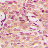 AKT1 Antibody - Immunohistochemical analysis of AKT staining in human breast cancer formalin fixed paraffin embedded tissue section. The section was pre-treated using heat mediated antigen retrieval with sodium citrate buffer (pH 6.0). The section was then incubated with the antibody at room temperature and detected using an HRP conjugated compact polymer system. DAB was used as the chromogen. The section was then counterstained with hematoxylin and mounted with DPX.