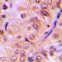AKT1 Antibody - Immunohistochemical analysis of AKT (pS473) staining in human breast cancer formalin fixed paraffin embedded tissue section. The section was pre-treated using heat mediated antigen retrieval with sodium citrate buffer (pH 6.0). The section was then incubated with the antibody at room temperature and detected using an HRP-conjugated compact polymer system. DAB was used as the chromogen. The section was then counterstained with hematoxylin and mounted with DPX.