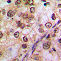 AKT1 Antibody - Immunohistochemical analysis of AKT (pY474) staining in human breast cancer formalin fixed paraffin embedded tissue section. The section was pre-treated using heat mediated antigen retrieval with sodium citrate buffer (pH 6.0). The section was then incubated with the antibody at room temperature and detected using an HRP-conjugated compact polymer system. DAB was used as the chromogen. The section was then counterstained with hematoxylin and mounted with DPX.