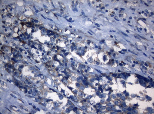 AKT1 Antibody - Immunohistochemical staining of paraffin-embedded Carcinoma of Human bladder tissue using anti-AKT1 mouse monoclonal antibody. (Heat-induced epitope retrieval by 1mM EDTA in 10mM Tris buffer. (pH8.5) at 120°C for 3 min. (1:150)