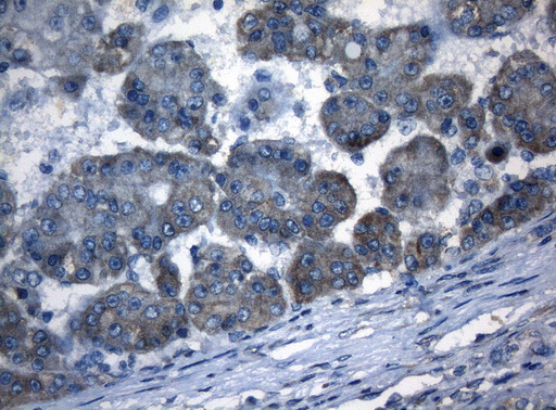 AKT1 Antibody - Immunohistochemical staining of paraffin-embedded Carcinoma of Human liver tissue using anti-AKT1 mouse monoclonal antibody. (Heat-induced epitope retrieval by 1mM EDTA in 10mM Tris buffer. (pH8.5) at 120°C for 3 min. (1:150)