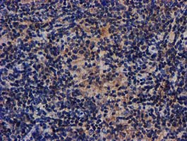 AKT1 Antibody - IHC of paraffin-embedded Human lymphoma tissue using anti-AKT1 mouse monoclonal antibody.