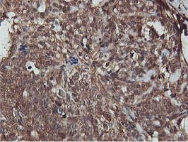 AKT1 Antibody - IHC of paraffin-embedded Adenocarcinoma of Human breast tissue using anti-AKT1 mouse monoclonal antibody.