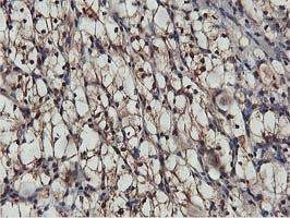 AKT1 Antibody - IHC of paraffin-embedded Carcinoma of Human kidney tissue using anti-AKT1 mouse monoclonal antibody.