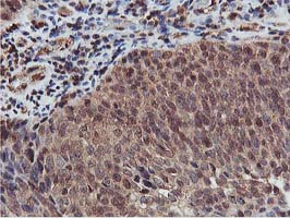 AKT1 Antibody - IHC of paraffin-embedded Carcinoma of Human bladder tissue using anti-AKT1 mouse monoclonal antibody.
