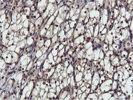 AKT1 Antibody - IHC of paraffin-embedded Carcinoma of Human kidney tissue using anti-AKT1 mouse monoclonal antibody.