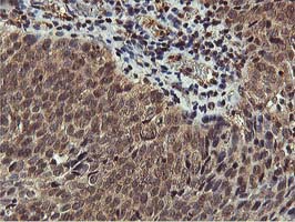 AKT1 Antibody - IHC of paraffin-embedded Carcinoma of Human bladder tissue using anti-AKT1 mouse monoclonal antibody.