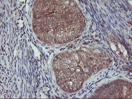 AKT1 Antibody - IHC of paraffin-embedded Adenocarcinoma of Human endometrium tissue using anti-AKT1 mouse monoclonal antibody.