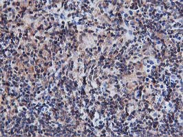 AKT1 Antibody - IHC of paraffin-embedded Human lymphoma tissue using anti-AKT1 mouse monoclonal antibody.