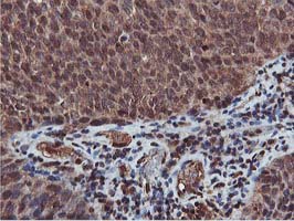 AKT1 Antibody - IHC of paraffin-embedded Carcinoma of Human bladder tissue using anti-AKT1 mouse monoclonal antibody. (Heat-induced epitope retrieval by 10mM citric buffer, pH6.0, 100C for 10min).