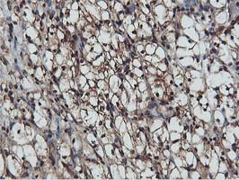 AKT1 Antibody - IHC of paraffin-embedded Carcinoma of Human kidney tissue using anti-AKT1 mouse monoclonal antibody. (Heat-induced epitope retrieval by 10mM citric buffer, pH6.0, 100C for 10min).