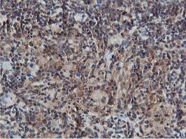 AKT1 Antibody - IHC of paraffin-embedded Human lymphoma tissue using anti-AKT1 mouse monoclonal antibody. (Heat-induced epitope retrieval by 10mM citric buffer, pH6.0, 100C for 10min).