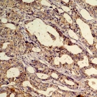 AKT1 Antibody - Immunohistochemical analysis of AKT1 staining in human breast cancer formalin fixed paraffin embedded tissue section. The section was pre-treated using heat mediated antigen retrieval with sodium citrate buffer (pH 6.0). The section was then incubated with the antibody at room temperature and detected using an HRP conjugated compact polymer system. DAB was used as the chromogen. The section was then counterstained with hematoxylin and mounted with DPX.