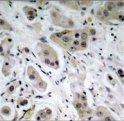 AKT1 Antibody - Detection of Akt (phospho-Ser473) in paraffin-embedded human breast carcinoma tissue.