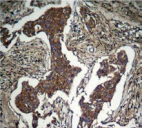 AKT1 Antibody - Detection of Akt (phospho-Ser473) in paraffin-embedded human lung carcinoma tissue.