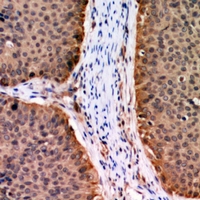 AKT1 Antibody - Immunohistochemical analysis of AKT (pT72) staining in human breast cancer formalin fixed paraffin embedded tissue section. The section was pre-treated using heat mediated antigen retrieval with sodium citrate buffer (pH 6.0). The section was then incubated with the antibody at room temperature and detected using an HRP conjugated compact polymer system. DAB was used as the chromogen. The section was then counterstained with haematoxylin and mounted with DPX.