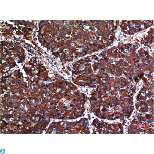 AKT1 Antibody - Immunohistochemistry (IHC) analysis of paraffin-embedded Human Breast Carcinoma Tissue using Akt Mouse Monoclonal Antibody diluted at 1:200.