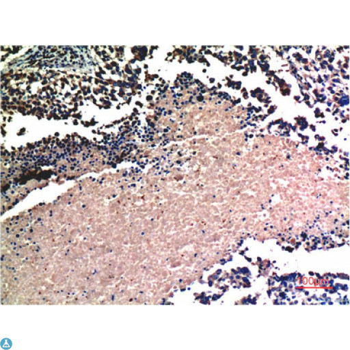 AKT1 Antibody - Immunohistochemistry (IHC) analysis of paraffin-embedded Human Lung Carcinoma Tissue using Akt Mouse Monoclonal Antibody diluted at 1:200.