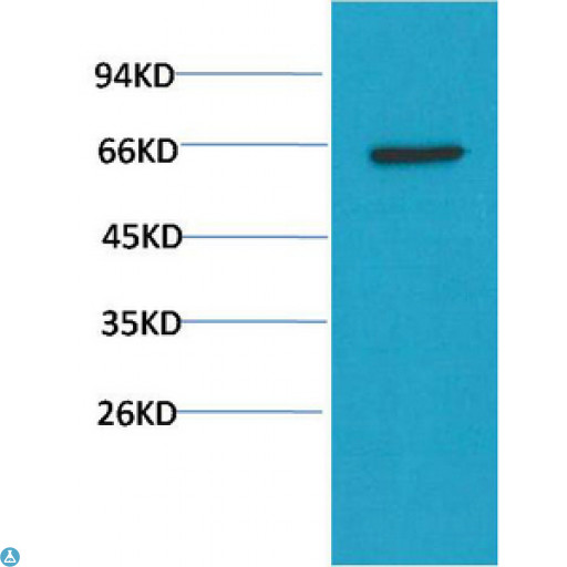 AKT1 Antibody - Immunohistochemistry (IHC) analysis of paraffin-embedded Human Lung Carcinoma Tissue using Akt Mouse Monoclonal Antibody diluted at 1:200.