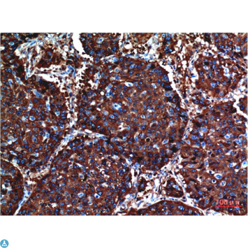 AKT1 Antibody - Immunohistochemistry (IHC) analysis of paraffin-embedded Human Breast Carcinoma Tissue using Akt Mouse Monoclonal Antibody diluted at 1:200.