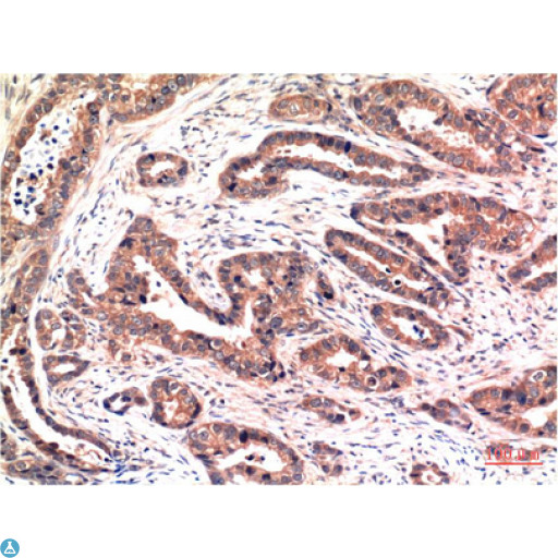AKT1 Antibody - Immunohistochemistry (IHC) analysis of paraffin-embedded Human Breast Carcinoma Tissue using Phospho-Akt Ser473 Mouse Monoclonal Antibody diluted at 1:200.
