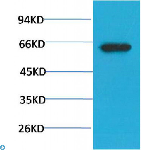 AKT1 Antibody - Immunohistochemistry (IHC) analysis of paraffin-embedded Human Lung Carcinoma Tissue using Phospho-Akt Ser473 Mouse Monoclonal Antibody diluted at 1:200.