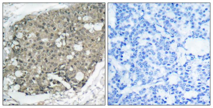 AKT1 Antibody - Peptide - + Immunohistochemical analysis of paraffin-embedded human breast carcinoma tissue using Akt (Ab-308) antibody.