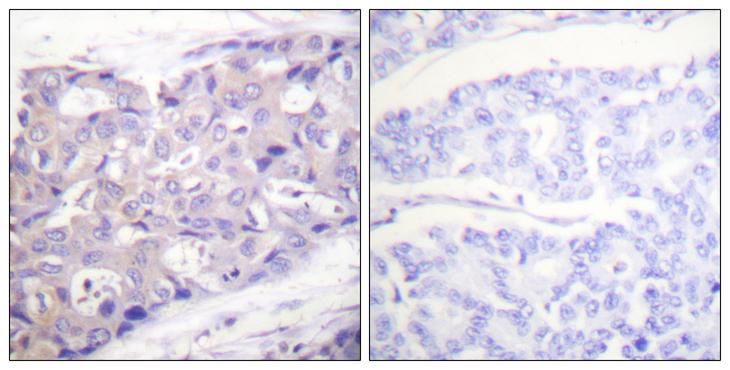 AKT1 Antibody - Peptide - + Immunohistochemistry analysis of paraffin-embedded human breast carcinoma tissue using Akt (Ab-326) antibody.