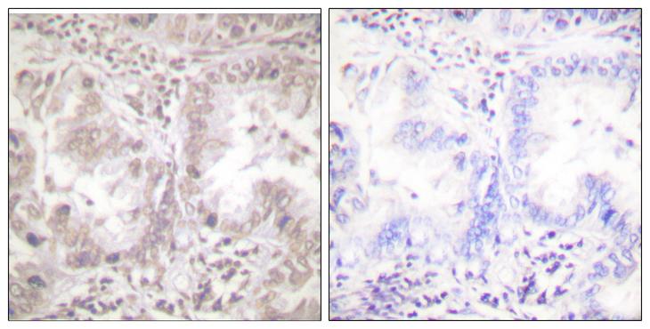 AKT1 Antibody - Peptide - + Immunohistochemical analysis of paraffin-embedded human lung carcinoma tissue using Akt (Ab-450) antibody.