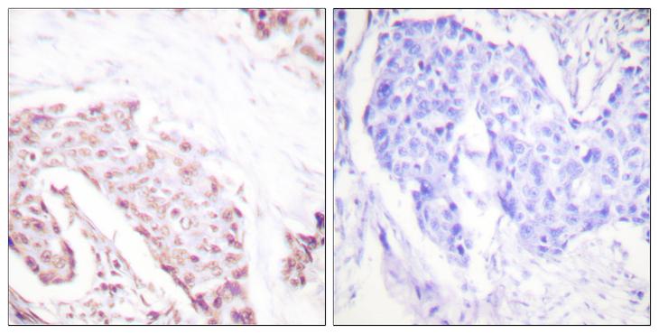 AKT1 Antibody - P-peptide - + Immunohistochemistry analysis of paraffin-embedded human breast carcinoma tissue using Akt (Phospho-Ser124) antibody.
