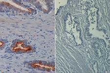 AKT1 Antibody - Immunohistochemistry of mouse anti AKT phospho S473 biotin conjugated at 40X (left) with negative control (right) Tissue: prostate Fixation: FFPE buffered formalin 10% conc Antigen retrieval: Heat, Citrate pH 6.2. Pressure Cooker Primary antibody: 20 g/mL for 1 h at RT Secondary antibody: Streptavidin Conj. HRP 10 ug/ml Localization: nuclear and occasionally cytoplasmic Staining: antibody as precipitated red signal with a hematoxylin purple nuclear counterstain. This image was taken for the unconjugated form of this product. Other forms have not been tested.