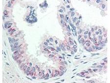 AKT1 Antibody - Immunohistochemistry of Mouse anti-AKT pS473 antibody. Tissue: human prostate tissue. Fixation: formalin fixed paraffin embedded. Antigen retrieval: not required. Primary antibody: AKT pS473 antibody at 20 µg/mL for 1 h at RT. Secondary antibody: Dako's Techmate streptavidin-biotin reagents at 1:10,000 for 45 min at RT. Localization: AKT pS473 is nuclear and occasionally cytoplasmic. Staining: AKT pS473 as precipitated red signal with hematoxylin purple nuclear counterstain.