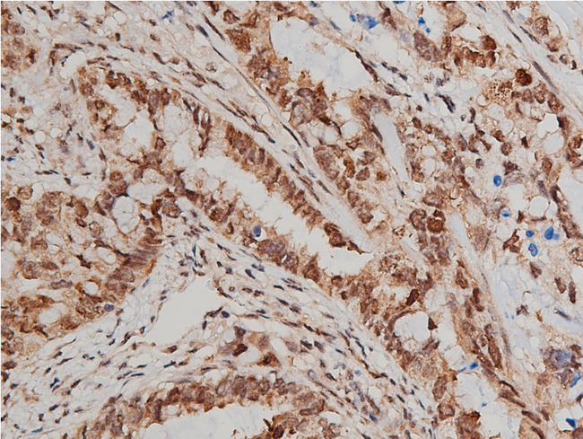 AKT1 Antibody - 1:200 staining human lung carcinoma tissue by IHC-P. The tissue was formaldehyde fixed and a heat mediated antigen retrieval step in citrate buffer was performed. The tissue was then blocked and incubated with the antibody for 1.5 hours at 22°C. An HRP conjugated goat anti-rabbit antibody was used as the secondary.
