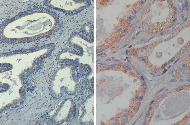 AKT1 Antibody - Immunohistochemistry of Mouse Anti-AKT phospho T308 Biotin Conjugated. Tissue: prostate at 20X (left) and 40X (right). Fixation: FFPE buffered formalin 10% conc. Antigen retrieval: Heat, Citrate pH 6.2. Pressure Cooker , Heat, EDTA pH 9.5 Pressure Cooker. Primary antibody: AKT pT308 biotin at 20 µg/mL for 1 h at RT. Secondary antibody: Streptavidin Conj. HRP at 10 ug/ml. Localization: nuclear and occasionally cytoplasmic. Staining: antibody as precipitated red signal with a hematoxylin purple nuclear counterstain.