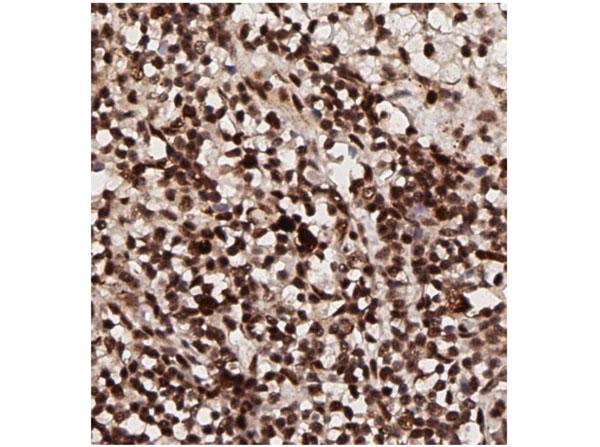 AKT1 Antibody - Immunohistochemistry of Rabbit Anti-AKT pT308 Antibody. Tissue: human breast tissue (lymph nodes). Antigen retrieval: HIER using citrate buffer for 20 minutes. Fixative: None. Primary Antibody: Anti-AKT phosphoT308 at 1:200 for 30 minutes at RT. Secondary Antibody: Anti-Rabbit Poly-HRP-IgG Ready to Use for 8 minutes at RT. Counterstain: Hematoxylin. Substrate: DAB. Analysis: Strong staining in nucleus. May be suitable with more dilutions.