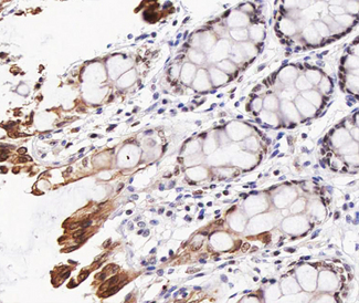 AKT1 Antibody - 1:200 staining human colon carcinoma tissue by IHC-P. The tissue was formaldehyde fixed and a heat mediated antigen retrieval step in citrate buffer was performed. The tissue was then blocked and incubated with the antibody for 1.5 hours at 22°C. An HRP conjugated goat anti-rabbit antibody was used as the secondary.