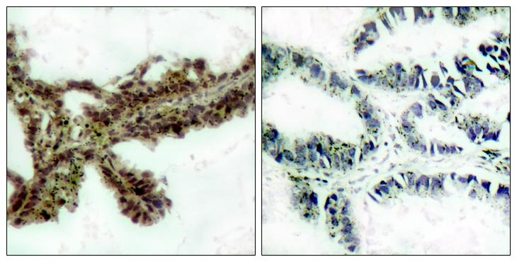 AKT1 Antibody - Immunohistochemical analysis of paraffin-embedded lung carcinoma, using Akt(Phospho-Thr308) Antibody. Left: Untreated; Right: Treated with synthesized phosphopeptide.