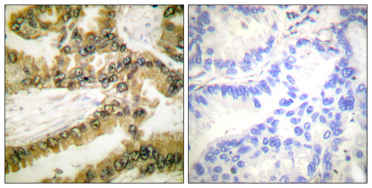 AKT1 Antibody - Immunohistochemistry analysis of paraffin-embedded human lung carcinoma, using Akt1 (Phospho-Thr450) Antibody. The picture on the right is blocked with the phospho peptide.